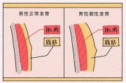 尴尬了男性乳房发育……