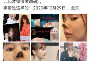 90后女演员晒医美失败照片曝光无良机构自言损失200万