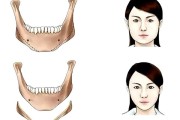 圣嘉新邱立东讲解：下颌角整形手术的费用大概是多少？