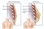 关注他的小尴尬——男性乳房发育可能是药物引起的